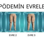 lipödemin_evreleri