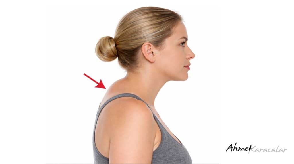 Ense Hörgücü (Buffalo Hump) Tedavisi